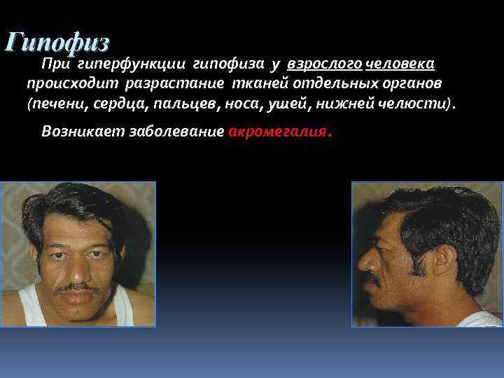Гипофиз При гиперфункции гипофиза у взрослого человека происходит разрастание тканей отдельных органов (печени, сердца,