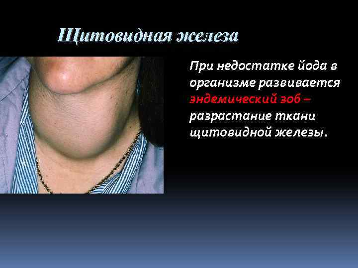 Щитовидная железа При недостатке йода в организме развивается эндемический зоб – разрастание ткани щитовидной