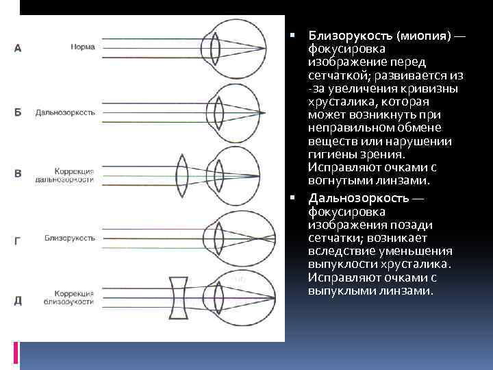  Близорукость (миопия) — фокусировка изображение перед сетчаткой; развивается из -за увеличения кривизны хрусталика,