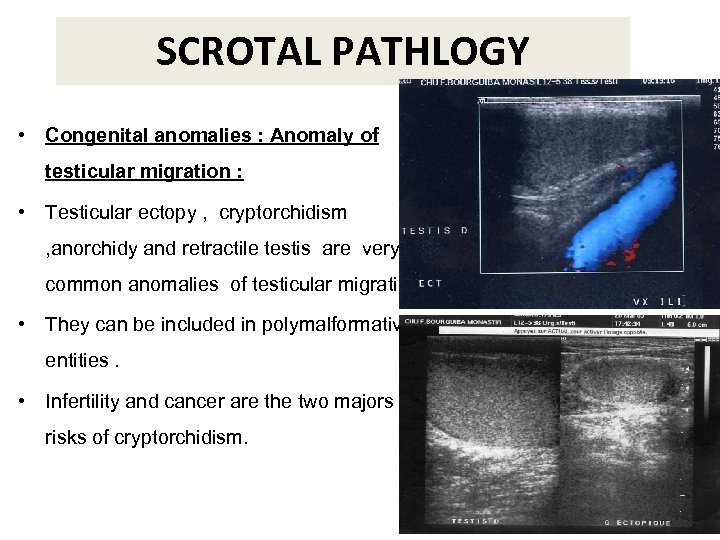 SCROTAL PATHLOGY • Congenital anomalies : Anomaly of testicular migration : • Testicular ectopy