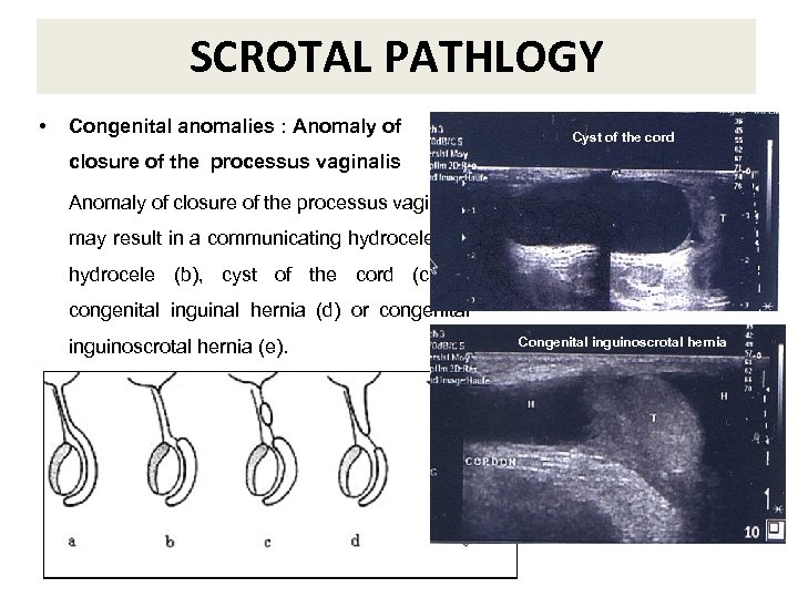 SCROTAL PATHLOGY • Congenital anomalies : Anomaly of Cyst of the cord closure of