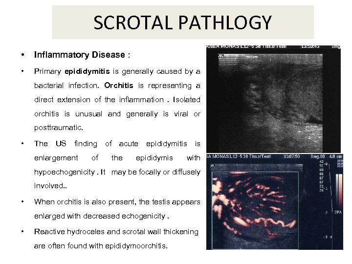 SCROTAL PATHLOGY • Inflammatory Disease : • Primary epididymitis is generally caused by a