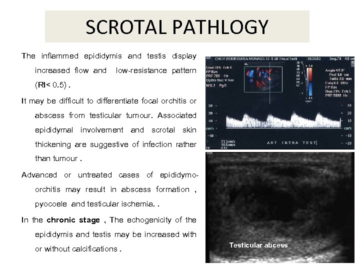 SCROTAL PATHLOGY The inflammed epididymis and testis display increased flow and low-resistance pattern (RI<