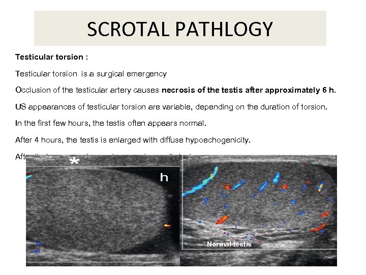 SCROTAL PATHLOGY Testicular torsion : Testicular torsion is a surgical emergency Occlusion of the