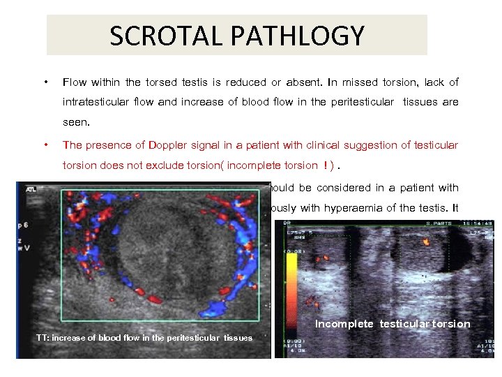 SCROTAL PATHLOGY • Flow within the torsed testis is reduced or absent. In missed