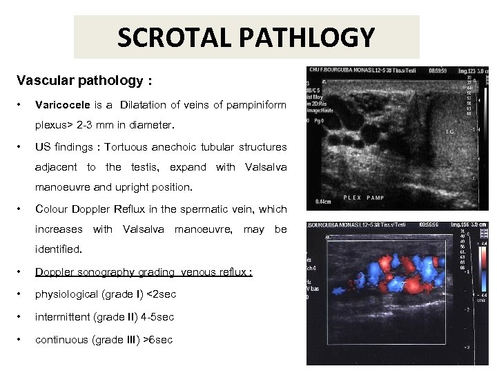 SCROTAL PATHLOGY Vascular pathology : • Varicocele is a Dilatation of veins of pampiniform