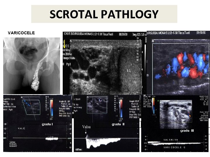 SCROTAL PATHLOGY VARICOCELE grade III 