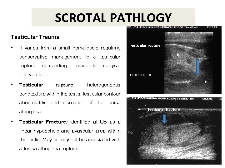 SCROTAL PATHLOGY Testicular Trauma • It varies from a small hematocele requiring Testicular rupture