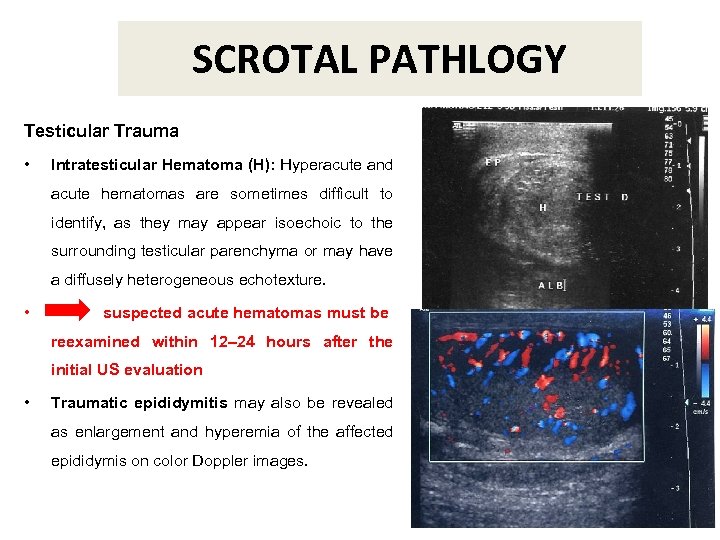 SCROTAL PATHLOGY Testicular Trauma • Intratesticular Hematoma (H): Hyperacute and acute hematomas are sometimes