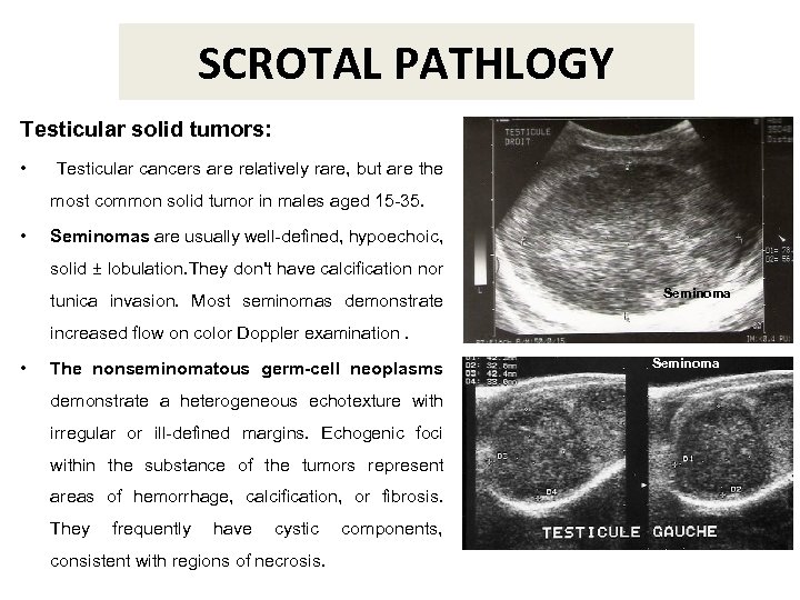 SCROTAL PATHLOGY Testicular solid tumors: • Testicular cancers are relatively rare, but are the