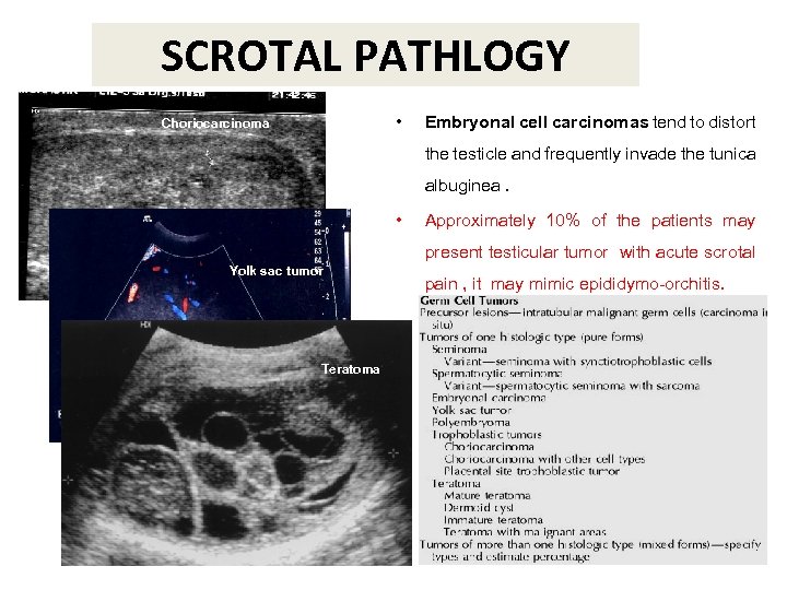 SCROTAL PATHLOGY • Choriocarcinoma Embryonal cell carcinomas tend to distort the testicle and frequently