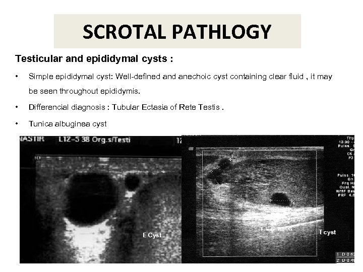 SCROTAL PATHLOGY Testicular and epididymal cysts : • Simple epididymal cyst: Well-defined anechoic cyst