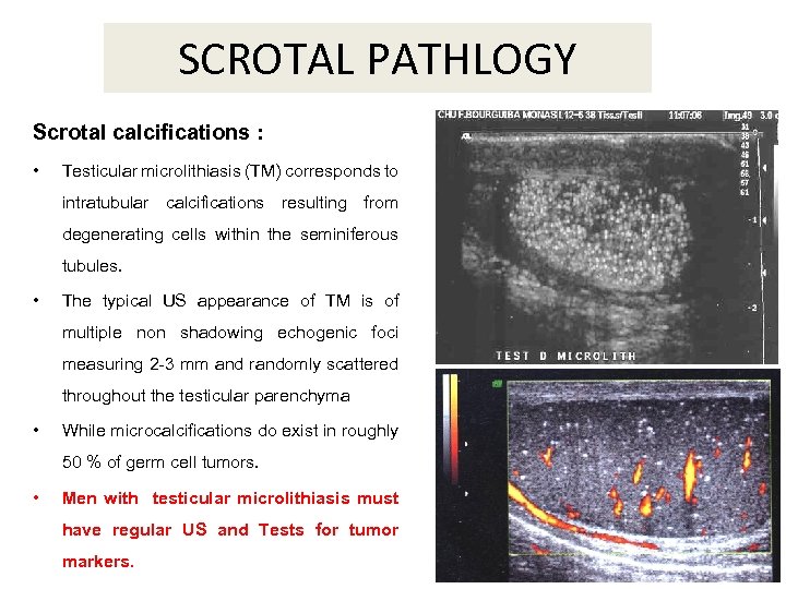 SCROTAL PATHLOGY Scrotal calcifications : • Testicular microlithiasis (TM) corresponds to intratubular calcifications resulting