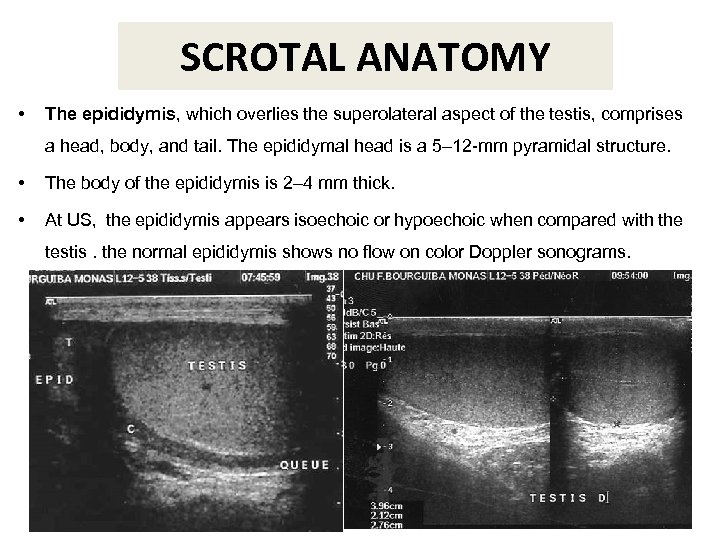 SCROTAL ANATOMY • The epididymis, which overlies the superolateral aspect of the testis, comprises