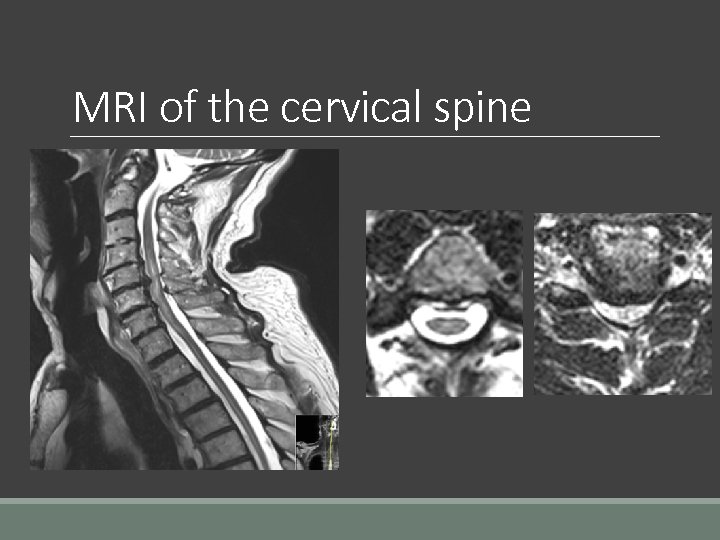 MRI of the cervical spine 