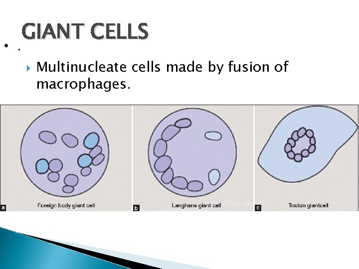  • . GIANT CELLS Multinucleate cells made by fusion of macrophages. 