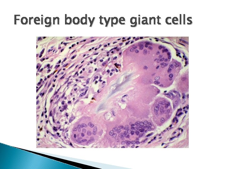 Foreign body type giant cells 