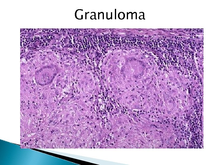 Granuloma 