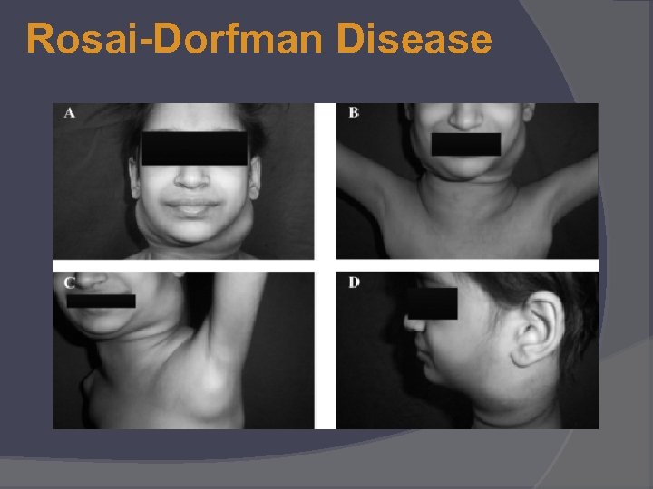 Rosai-Dorfman Disease 