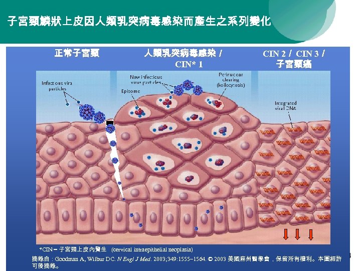 子宮頸鱗狀上皮因人類乳突病毒感染而產生之系列變化 正常子宮頸 人類乳突病毒感染／ CIN* 1 *CIN = 子宮頸上皮內贅生 (cervical intraepithelial neoplasia) CIN 2／ CIN