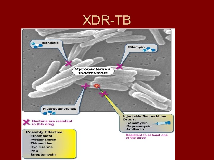 XDR-TB 