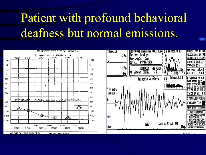 Patient with profound behavioral deafness but normal emissions. 