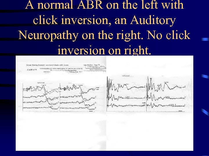 A normal ABR on the left with click inversion, an Auditory Neuropathy on the