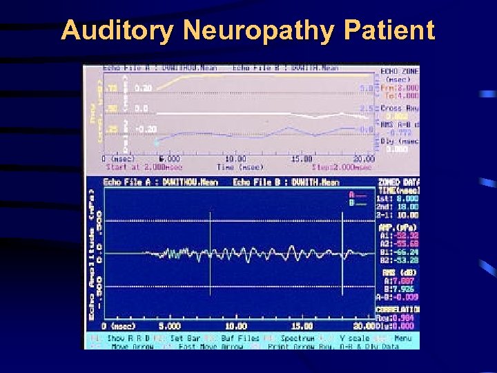 Auditory Neuropathy Patient 