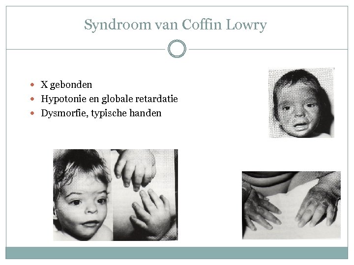 Syndroom van Coffin Lowry X gebonden Hypotonie en globale retardatie Dysmorfie, typische handen 