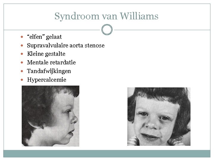 Syndroom van Williams “elfen” gelaat Supravalvulaire aorta stenose Kleine gestalte Mentale retardatie Tandafwijkingen Hypercalcemie