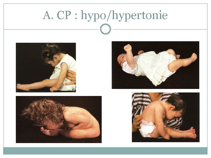 A. CP : hypo/hypertonie 