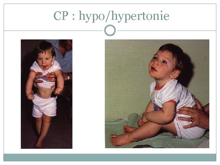  CP : hypo/hypertonie 