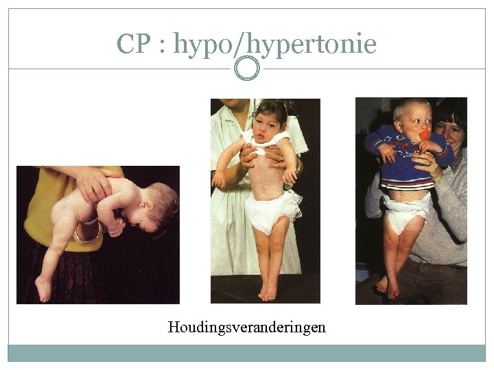 CP : hypo/hypertonie Houdingsveranderingen 