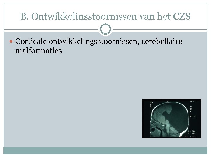 B. Ontwikkelinsstoornissen van het CZS Corticale ontwikkelingsstoornissen, cerebellaire malformaties 