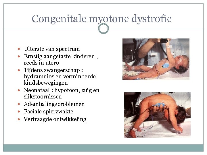 Congenitale myotone dystrofie Uiterste van spectrum Ernstig aangetaste kinderen , reeds in utero Tijdens