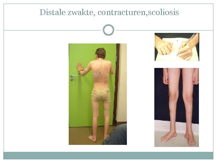 Distale zwakte, contracturen, scoliosis 