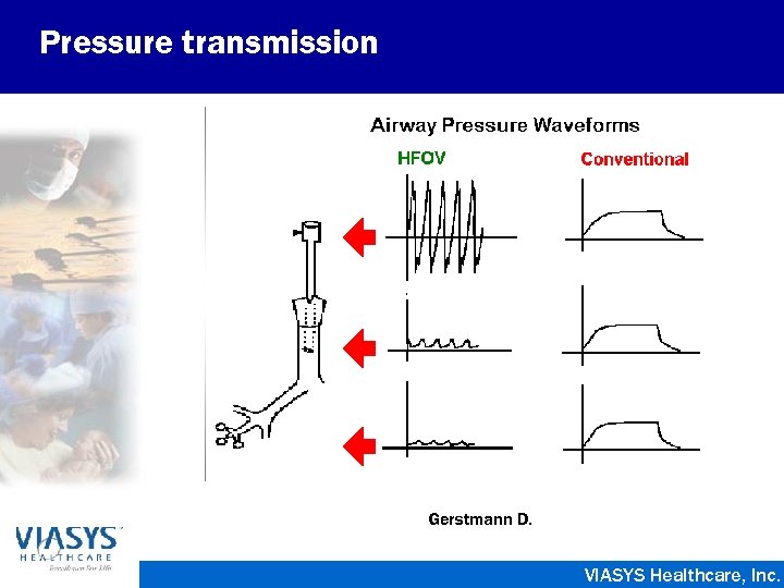 Pressure transmission Gerstmann D. VIASYS Healthcare, Inc. 