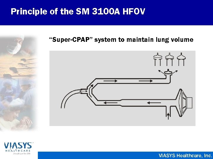 Principle of the SM 3100 A HFOV “Super-CPAP” system to maintain lung volume VIASYS