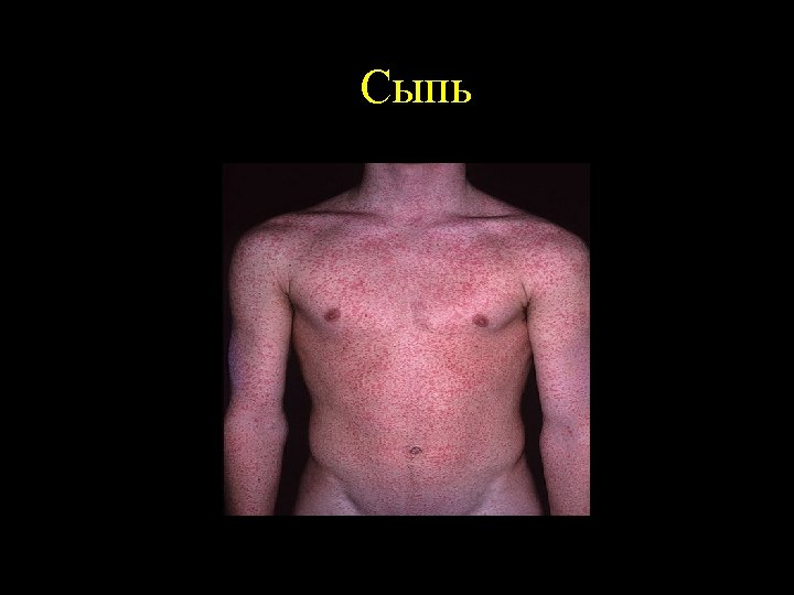 Сыпь 