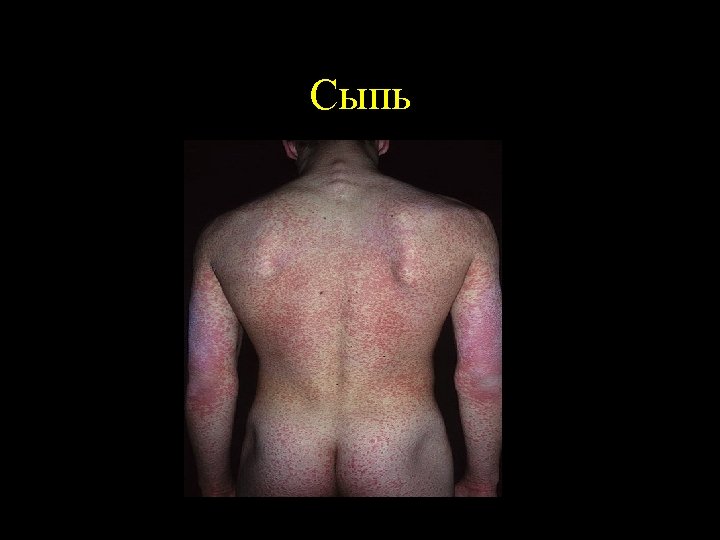 Сыпь 