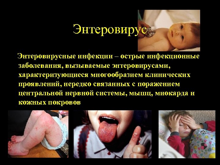 Энтеровирусные инфекции – острые инфекционные заболевания, вызываемые энтеровирусами, характеризующиеся многообразием клинических проявлений, нередко связанных