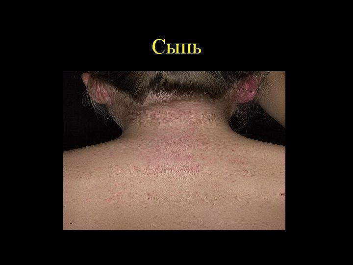 Сыпь 