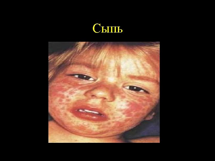 Сыпь 