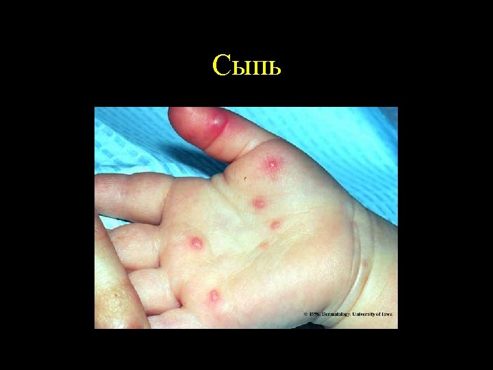 Сыпь 