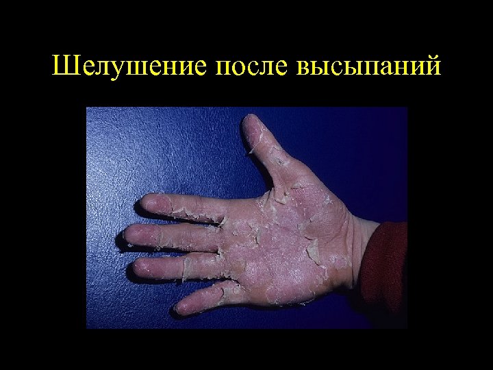 Шелушение после высыпаний 