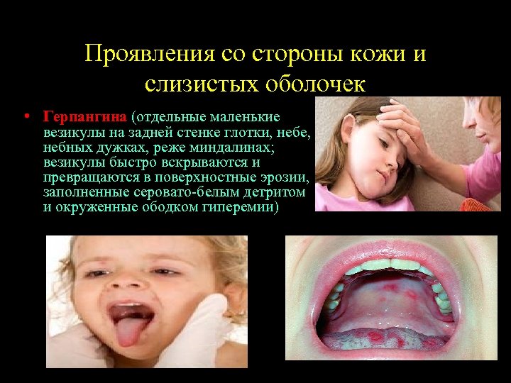 Проявления со стороны кожи и слизистых оболочек • Герпангина (отдельные маленькие везикулы на задней