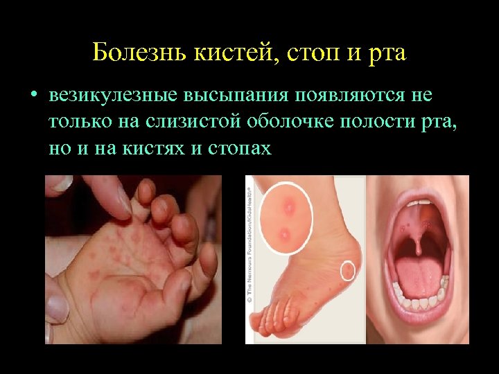Болезнь кистей, стоп и рта • везикулезные высыпания появляются не только на слизистой оболочке