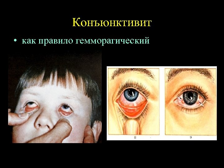 Конъюнктивит • как правило гемморагический 