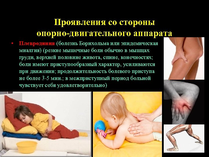 Проявления со стороны опорно-двигательного аппарата • Плевродиния (болезнь Борнхольма или эпидемическая миалгия) (резкие мышечные