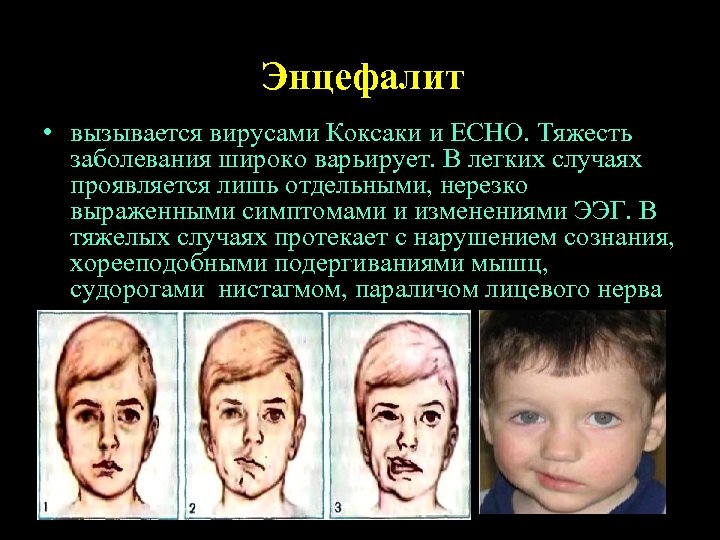 Энцефалит • вызывается вирусами Коксаки и ECHO. Тяжесть заболевания широко варьирует. В легких случаях